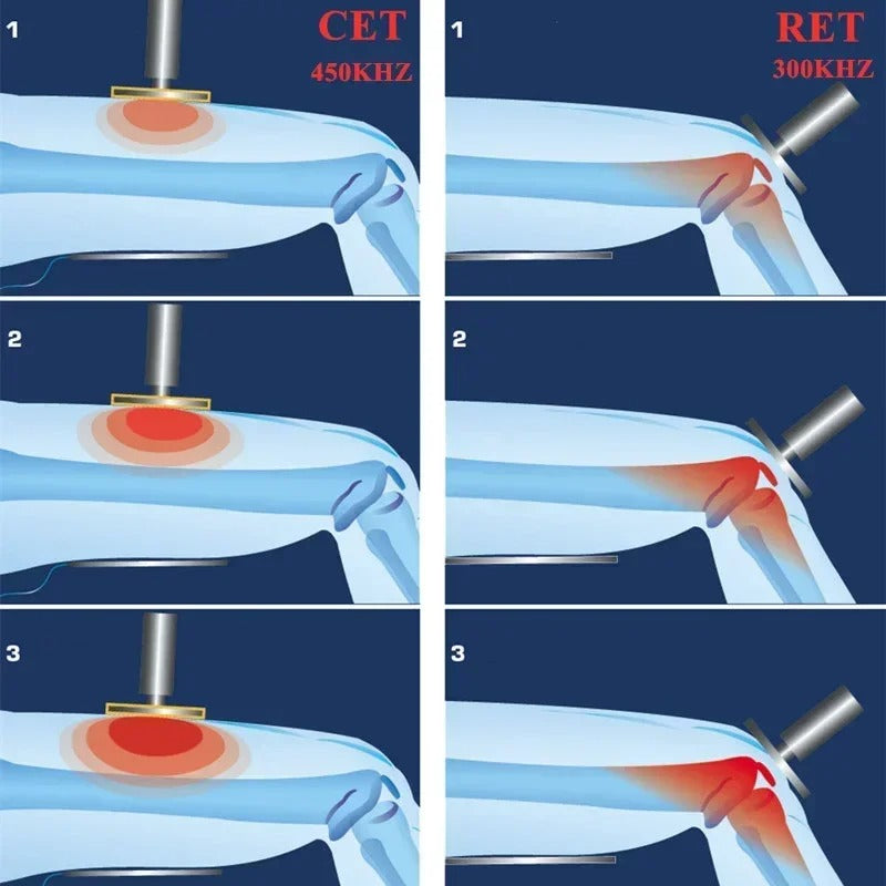 448KHz Smart Tecar Therapy Diathermy Body Massage Deep Heating Device with CET and RET handles